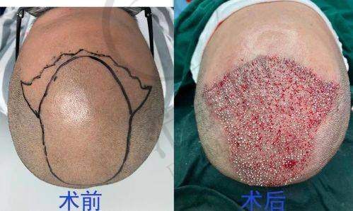 杭州胡须种植哪个医生好——浙江大学医学校附属邵逸夫医院整形外科