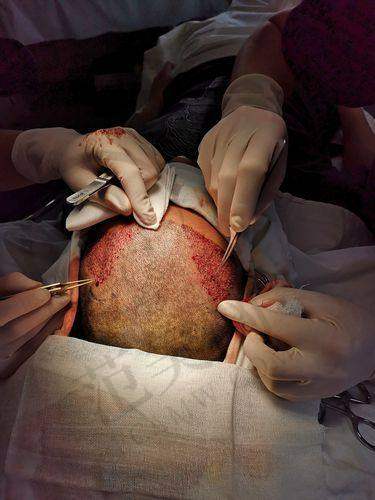 杭州胡须种植哪个医生好——杭州中医院