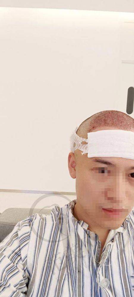 杭州胡须种植哪个医生好——杭州维俪肤医疗整形