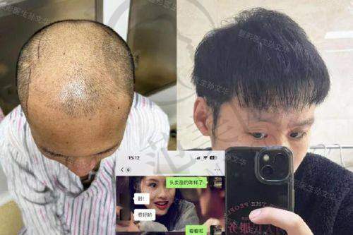 杭州胡须种植哪个医生好——杭州萧山第一人民医院医疗美容科