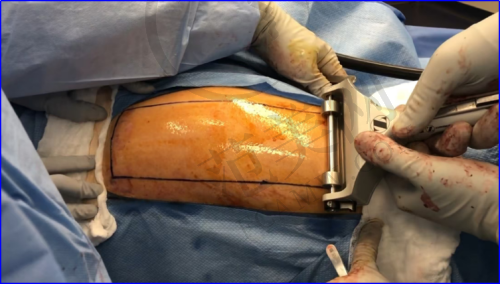 杭州大腿吸脂专家是谁?艺星翟爽/星光丽格汪峰/维多利亚马腾等擅长微创吸脂