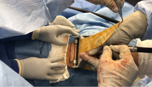 杭州大腿吸脂骨干医生——杭州连天美医疗美容医院