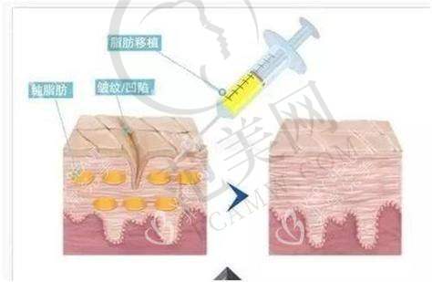 杭州大腿吸脂骨干医生——杭州薇琳医疗美容医院