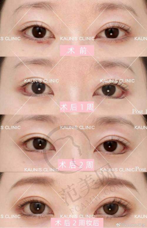 杭州双眼皮医生哪个好——杭州艺星医疗美容医院