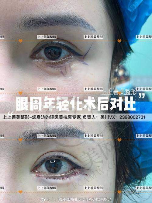 杭州眉毛种植更具有影响力的医院口碑排名 - 杭州市余杭区中医院