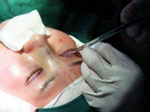 杭州胎记疤痕治疗——杭州连天美医疗美容医院