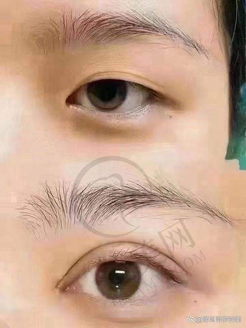 杭州胎记疤痕治疗——杭州简美医疗整形