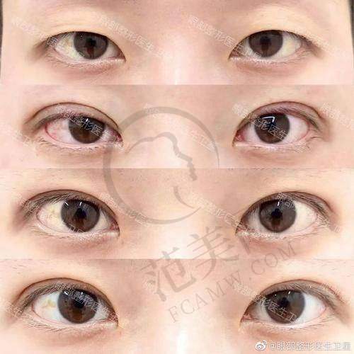 杭州双眼皮医生哪个好——杭州薇琳医疗美容医院