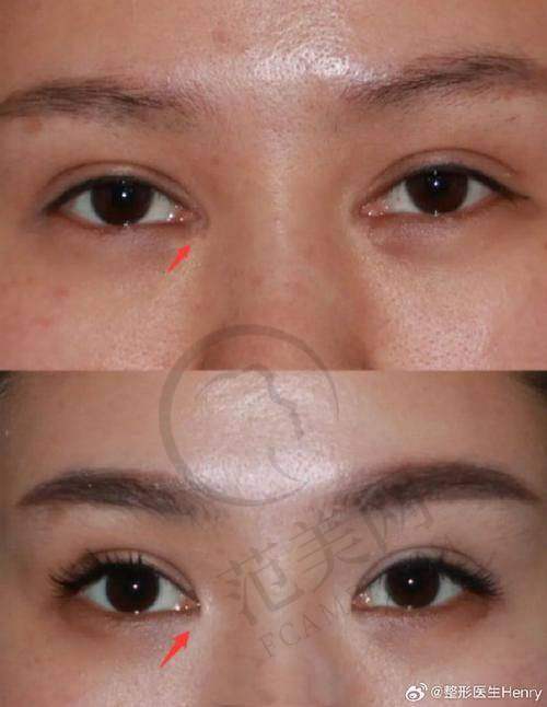 杭州双眼皮医生哪个好——杭州瑞丽医疗美容医院