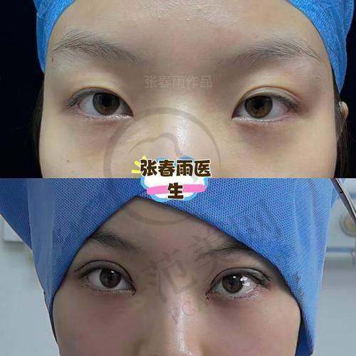 杭州双眼皮医生哪个好——杭州米兰柏羽医疗美容医院