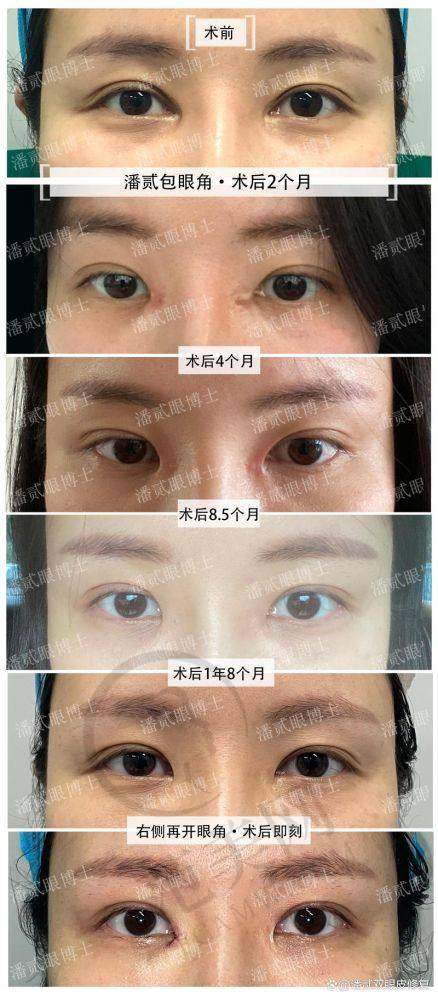 杭州双眼皮医生哪个好——杭州EG童颜医疗美容