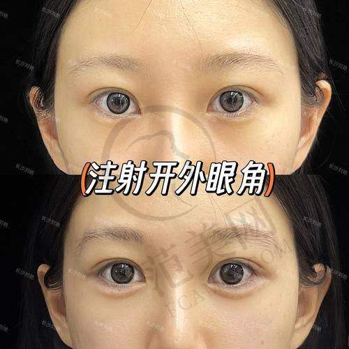 杭州双眼皮医生哪个好——杭州时光整形美容医院