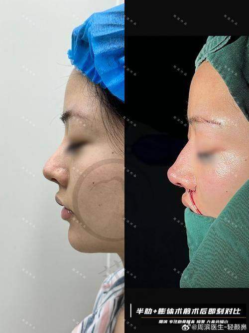 杭州胎记疤痕治疗——杭州市第一人民医院整形外科