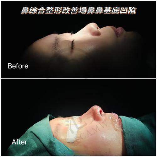 杭州眉毛种植更具有影响力的医院口碑排名 - 浙江省人民医院整形外科