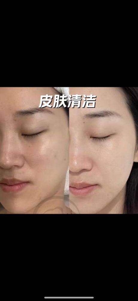 杭州眉毛种植更具有影响力的医院口碑排名 - 杭州第一人民医院医学美容科