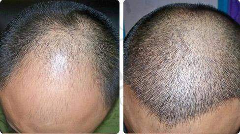 杭州鬓角种植多少钱左右:杭州第一人民/碧莲盛6800起,张菊芳/沈海燕经验足