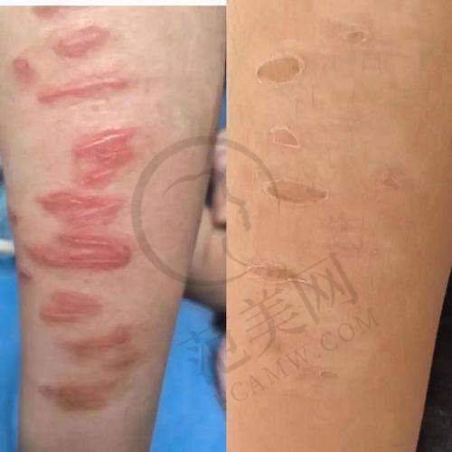 杭州胎记疤痕治疗——杭州清沐医疗美容门诊部