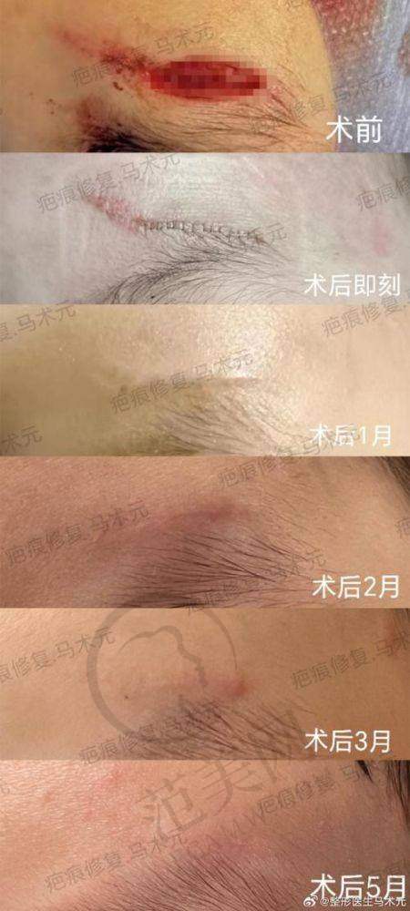 杭州胎记疤痕治疗——杭州伊甸媛医疗美容