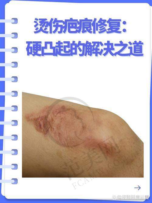 杭州胎记疤痕治疗——杭州童颜医疗美容医院