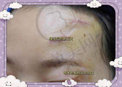 杭州胎记疤痕治疗——杭州芳华&青橙医疗美容