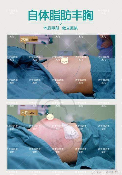 杭州自体脂肪去法令纹预约门诊——杭州薇琳医疗美容医院