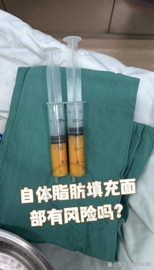 杭州自体脂肪去法令纹预约门诊——杭州静港医疗美容诊所