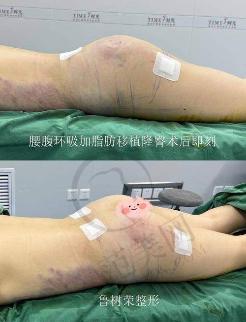 杭州自体脂肪去法令纹预约哪个门诊?适合30岁中重度法令纹 效果维持6-12个月 术后当天可正常生活