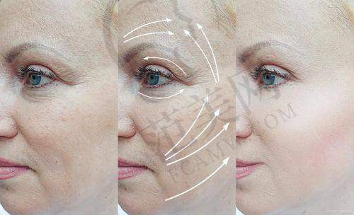 杭州嗨体祛颈纹医生排名——杭州君曼医疗美容会所