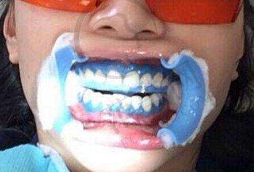 上海维乐口腔医院牙体牙髓病治疗项目