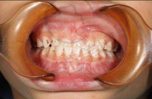 上海维乐口腔做地包天谁做的最好，专家王建文和黄庆巍技术精湛，个性化方案更贴心 