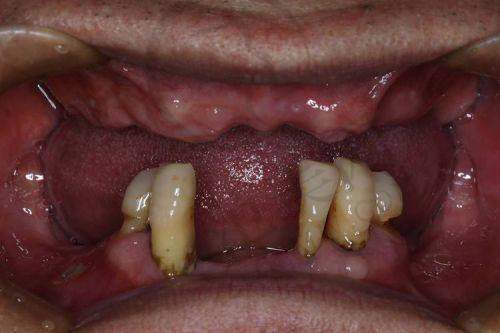 三、胡礼明医生做手术多少钱?各口腔项目收费详情