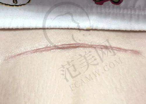 海口鹏爱整形收费价格